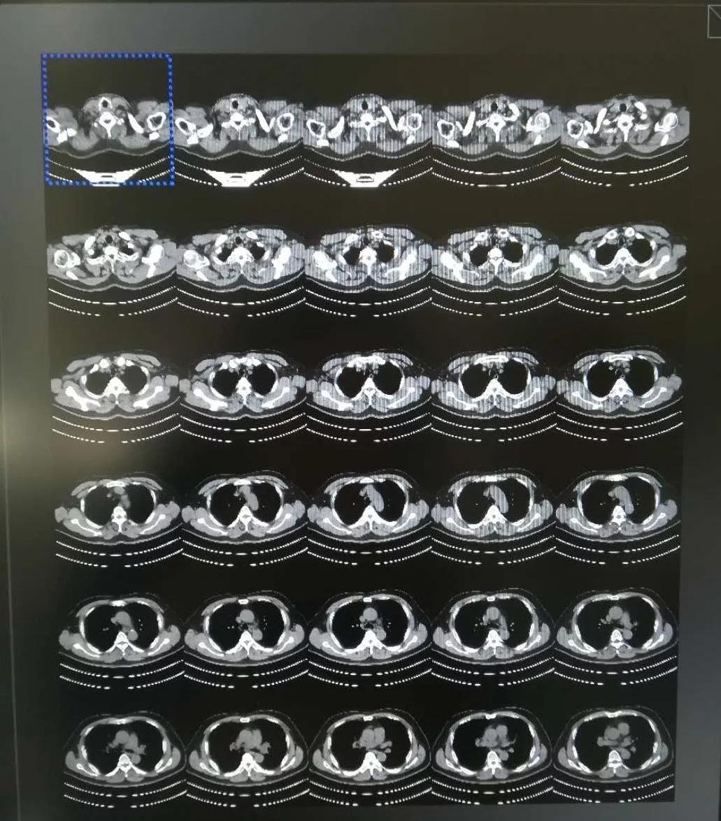 【影像】超简单鼻窦CT入门教程 Basic CT anatomy of paranasal sinuses made easy｜医学英语｜油管 ...