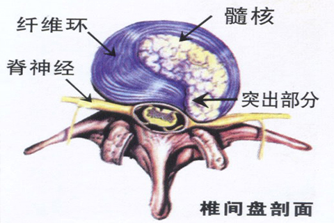 腰椎间盘突出健康宣教