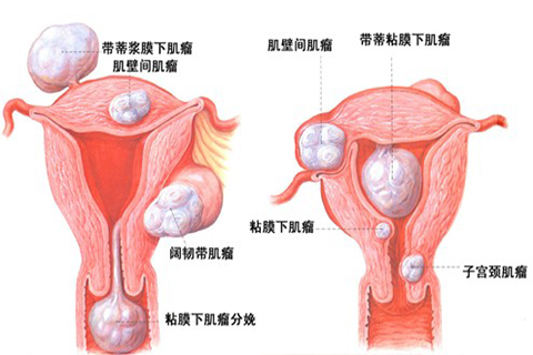 子宫肌瘤健康宣教