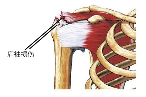 肩袖损伤健康宣教