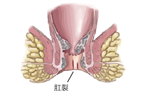 肛裂