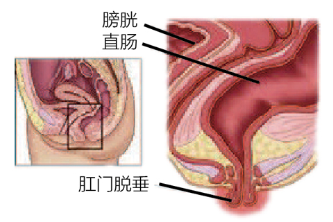 直肠脱垂